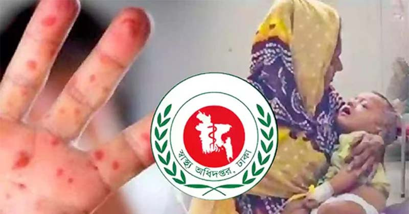 দেশে হাম ও উপসর্গে আরো ৫ শিশুর মৃত্যু